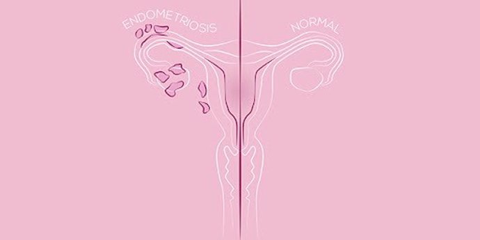 Archivo - Endometriosis