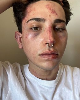 Lesiones tras la agresión homófoba denunciada por un joven en una discoteca de Valncia