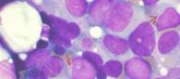 Foto: Hematólogos elogian el esfuerzo investigador para el tratamiento de la leucemia mieloblástica aguda