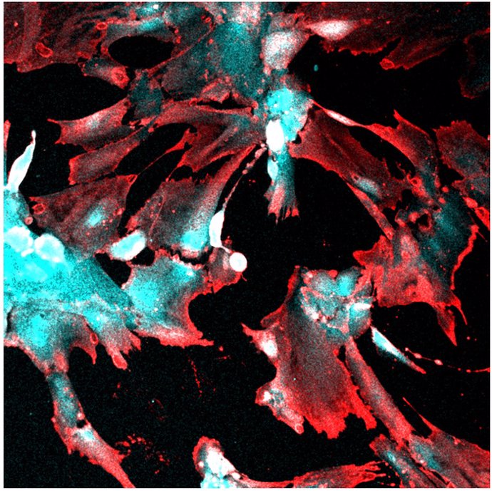 Imagen que muestra una fuerte captación de SARS-CoV-2 por podocitos renales derivados de células madre. Las células infectadas expresan la proteína de la nucleocápside viral (rojo) y el marcador de identificación del linaje celular podocitario (cian).