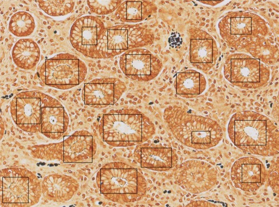 Detección automática de infección por Helicobacter pylori en una sección de biopsia gástrica procesada con tinción de Warthin-Starry