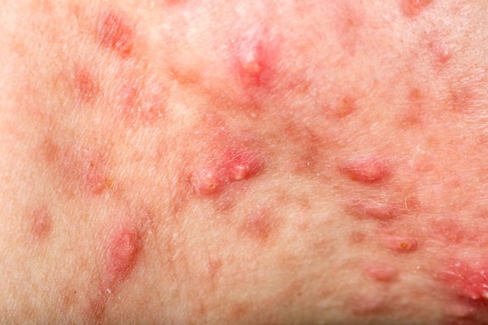 Archivo - Nodular cystic acne skin