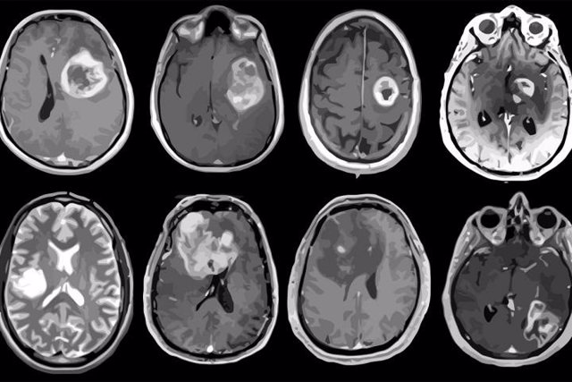 Archivo - Glioblastoma, tumor cerebral agresivo mapeado en detalle genético y molecular.