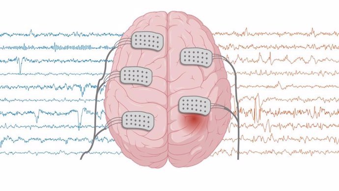 Representación gráfica: las señales son reales de la base de datos que se utilizó en el estudio. El punto rojo indica el foco epiléptico en un hemisferio. Las señales en naranja indican las señales focales, azul las no focales.