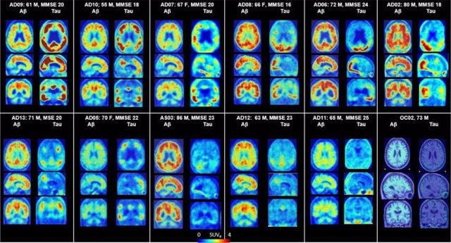 Archivo - PET del cerebro que muestra placas amiloides y proteínas tau en Alzheimer