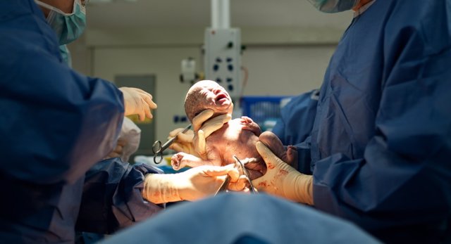 Archivo - Baby being born via Caesarean Section