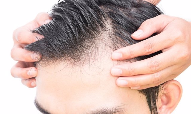 Archivo - Young man serious hair loss problem for hair loss concept