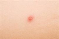 El ECDC informa de 5 casos confirmados de la viruela del mono y más de 20 casos sospechosos en Portugal