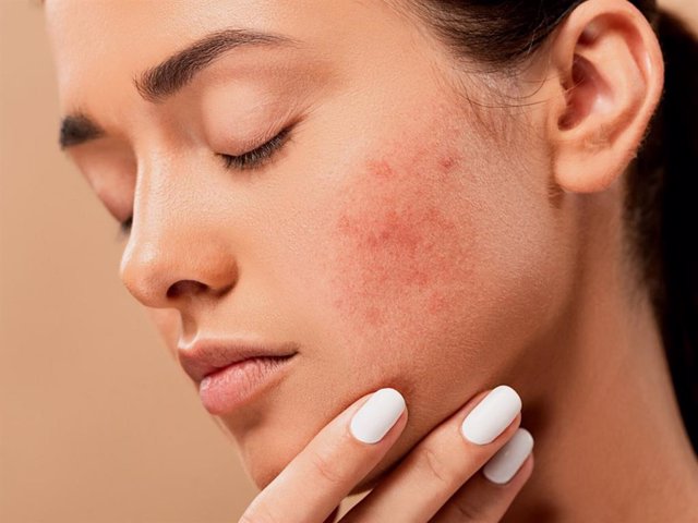 Archivo - El acné es un problema cutáneo que cada vez afecta a más gente