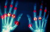 Foto: Los genes pueden predecir la respuesta al tratamiento de la artritis