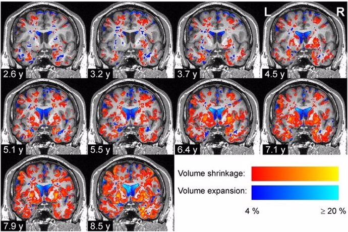 Degeneración progresiva del tejido cerebral en un paciente con enfermedad de Parkinson.
