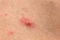 Europa llega a los 67 casos de viruela del mono