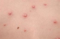 ¿La vacuna de la viruela nos protege de la viruela del mono? ¿qué pasa con los no vacunados?¿tenemos que estar alerta?