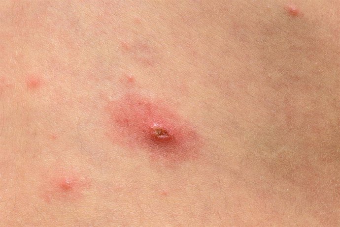 Archivo - Varicella, virus, verola, recurs