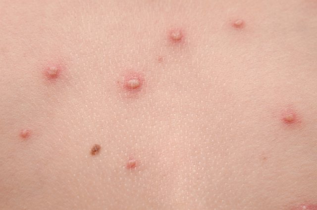 Virus, Viruela, Zoster, Varicela, grano, recurso