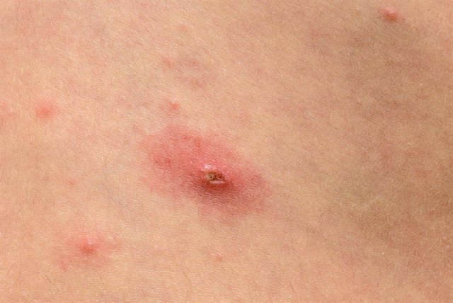 Archivo - Varicel·la, virus, verola, recurs