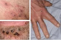 España recibe unos "pocos" tratamientos contra la viruela del mono y llegarán "con carácter inminente" 200 vacunas