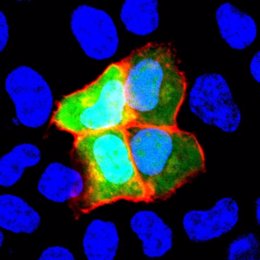 NCAM1 se induce sólo en las células verdes (células HeLa). El suero de pacientes con autoanticuerpos anti-NCAM1 reacciona sólo en las células verdes (enmarcadas en rojo).
