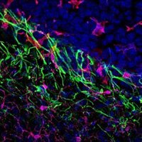 Un nuevo fármaco muestra su eficacia preclínica para tratar mejor la metástasis cerebral causada por melanoma