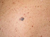 SEOM asegura que la detección precoz, la inmunoterapia y las terapias dirigidas mejoran la supervivencia en melanoma