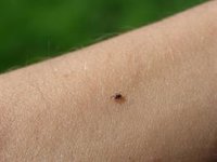 La enfermedad de Lyme, ¿cómo nos afecta esta enfermedad transmitida por garrapatas?