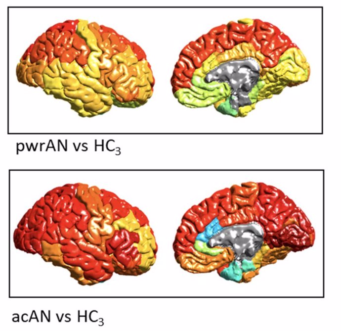 Estos mapas cerebrales muestran (en colores más cálidos) las regiones cerebrales con déficits de materia gris en la anorexia. Los déficits son menos acusados en personas parcialmente recuperadas (arriba) que en los de fase aguda (abajo).