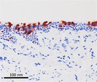 Las personas infectadas con ómicron pueden reinfectarse con sus subvariantes