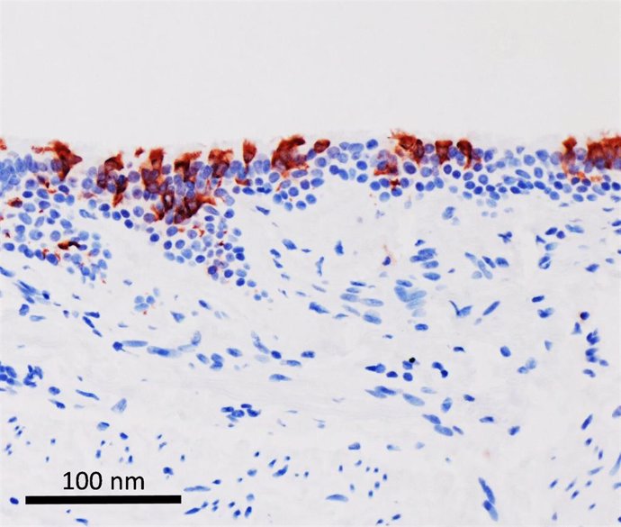Archivo - La variante omicrón del SARS-CoV-2 (en rojo) infectando tejidos de bronquios humanos.