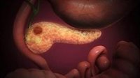 Una colaboración internacional propone un análisis de heces para la detección temprana del cáncer de páncreas