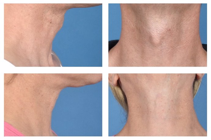 Fotos de un paciente antes (fila superior) y después (fila inferior) de la cirugía en la UCLA para reducir el tamaño de la nuez sin una cicatriz visible.