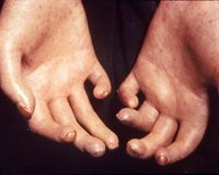 Boehringer Ingelheim y Asociación Española de Esclerodermia visibilizan los síntomas y retos de la enfermedad
