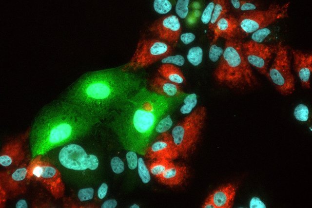 Archivo - Replicación del virus de la hepatitis C (VHC) y del virus de la hepatitis E (VHE) en células hepáticas humanas. El VHC produce una señal roja, el VHE produce una señal verde cuando se multiplica con éxito.