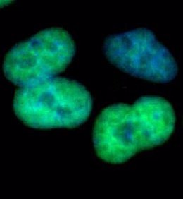Células humanas de cáncer de pulmón que expresan la proteína EZH2.