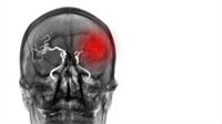 Algunos fármacos para la presión arterial pueden disminuir el riesgo de rotura de aneurismas