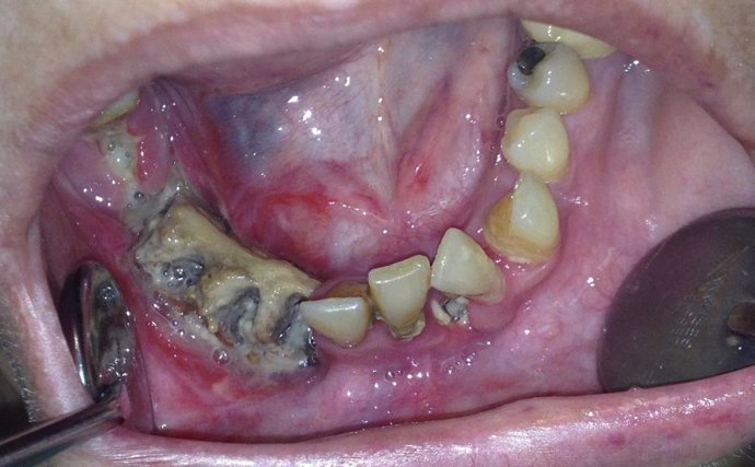 Imagen de paciente afectada de osteonecrosis mandibular por bifosfonatos