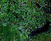 El carvedilol puede prevenir la descompensación de la cirrosis y mejorar la supervivencia en cirrosis compensada