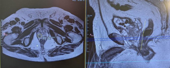 Imagen de bipsia de próstata por fusión