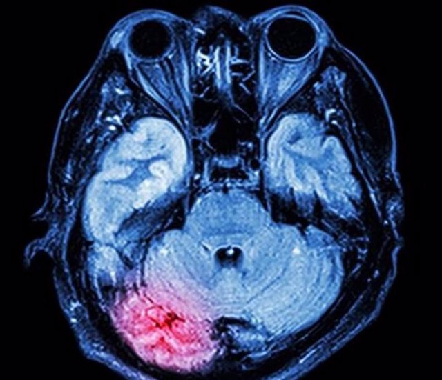 Archivo - La zona roja muestra el lugar donde se inflama el cerebro después de una conmoción cerebral.