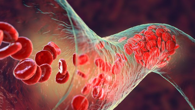 Archivo - Coágulo de sangre hecho de glóbulos rojos, plaquetas y hebras de proteína de fibrina