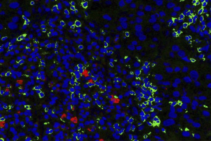 Archivo - Imagen de un carcinoma infiltrante de mama HER2-positivo, donde se muestra los limfocitos NK (en rojo) y los limfocitos T (verdes) presentes en el estroma tumor
