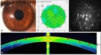 Empresas.- Vissum Grupo Miranza realiza un implante de células madre para tratar la distrofia corneal