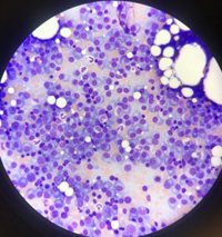 Detienen el crecimiento del mieloma múltiple y de un linfoma con una molécula personalizada, en pruebas con ratones