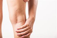 ¿Cómo hacer frente a las piernas hinchadas en verano?