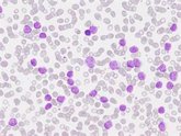 Foto: Un estudio completa el mapa de los cambios genéticos en la leucemia linfática crónica