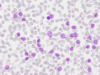 Un estudio completa el mapa de los cambios genéticos en la leucemia linfática crónica