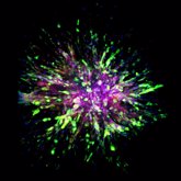 Foto: Científicos identifican biomarcadores moleculares en las células que propagan la forma más mortal de cáncer de mama