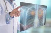 Foto: La incidencia de un segundo cáncer de pulmón primario es del 4% y llega al 8% en pacientes operados