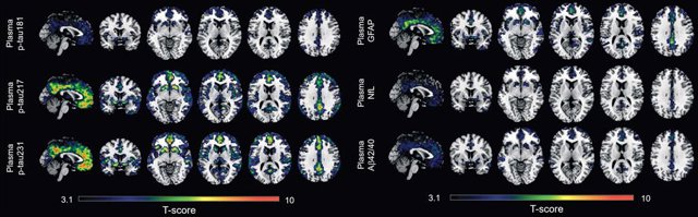 Un estudi identifica dos biomarcador en sang per captar els primers indicis de l'Alzheimer