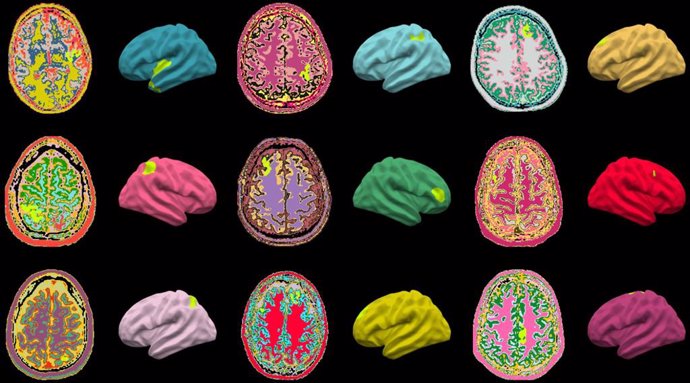 Anomalías cerebrales identificadas por el algoritmo MELD AI (resaltadas en verde lima) en resonancias magnéticas de niños y adultos con epilepsia de todo el mundo.
