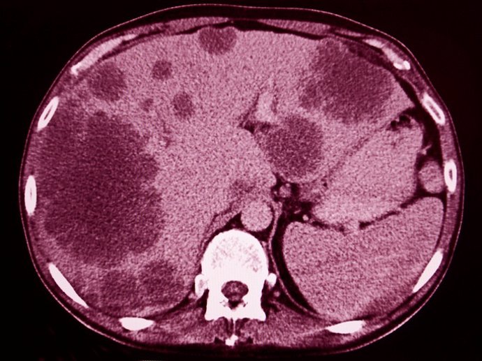 Archivo - Liver tumors -CT